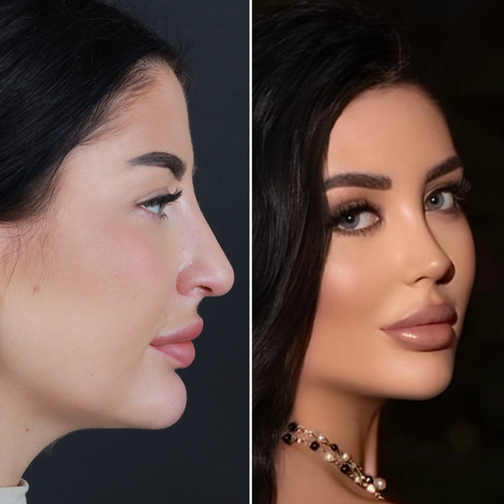 Before and After