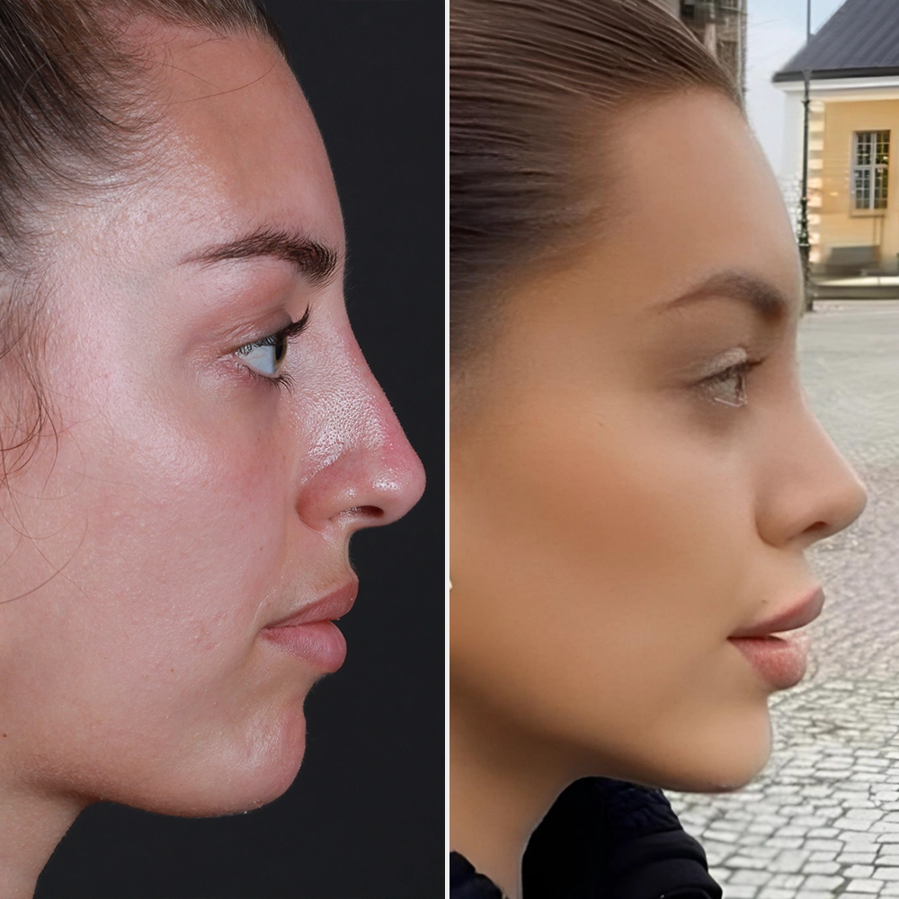 Before and After