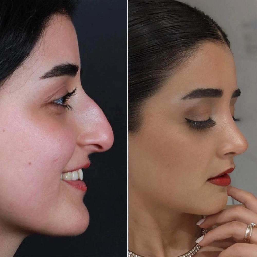 Before and After